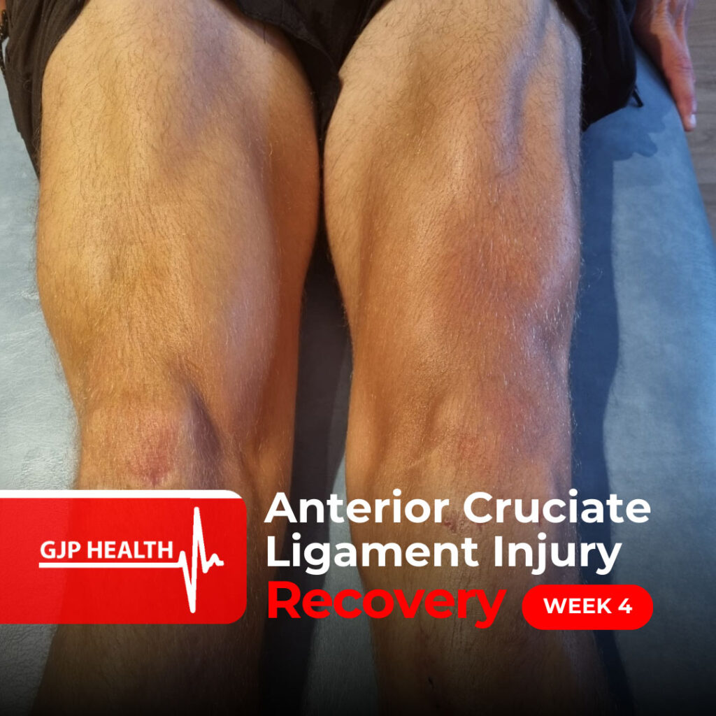 Patient Journey with Anterior Cruciate Ligament Rupture injury
